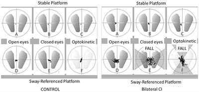 Effect of Rotating Auditory Scene on Postural Control in Normal Subjects, Patients With Bilateral Vestibulopathy, Unilateral, or Bilateral Cochlear Implants